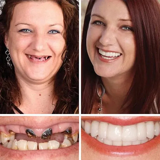 Custom-Fit Instant Smile Dentures – Natural Looking Comfort Fit