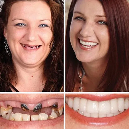 Custom-Fit Instant Smile Dentures – Natural Looking Comfort Fit